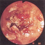 Abb. 78: Colitis ulcerosa